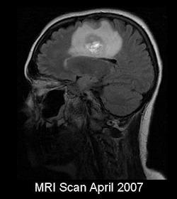 glioblastoma multiforme